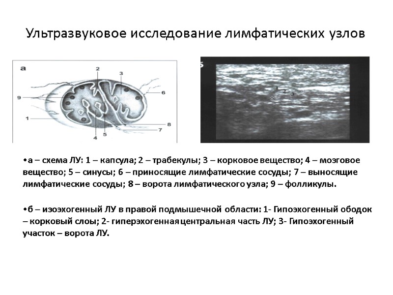 Ультразвуковое исследование лимфатических узлов а – схема ЛУ: 1 – капсула; 2 – трабекулы;